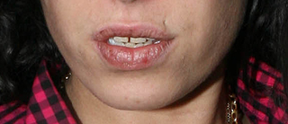 Illustration for article titled Paging Dr. Jezebel: Does Amy Winehouse Have Oral Cancer?